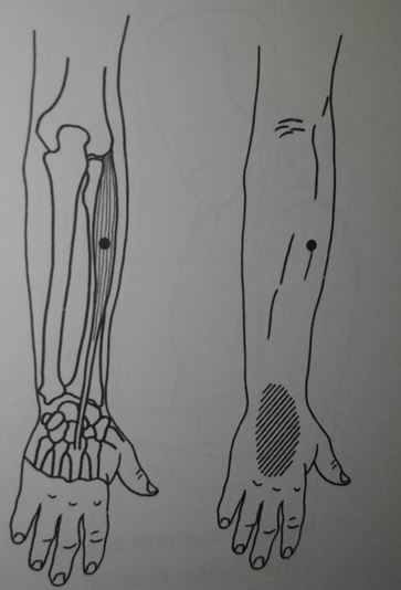 triggerpoints-in-de-korte-strekker-naar-de-duimzijde-extensor-carpi-radialis-brevis-pijn-in-handpalm