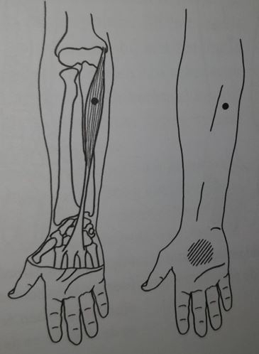 triggerpoints-in-de-lange-handpalmspier-palmaris-longus