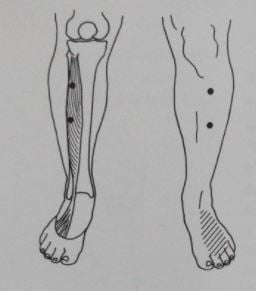 Triggerpoints in de lange strekker van de tenen Extensor Digitorum Longusscheenbeenklachten