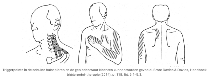 triggerpoints-in-de-schuine-halsspieren-cts