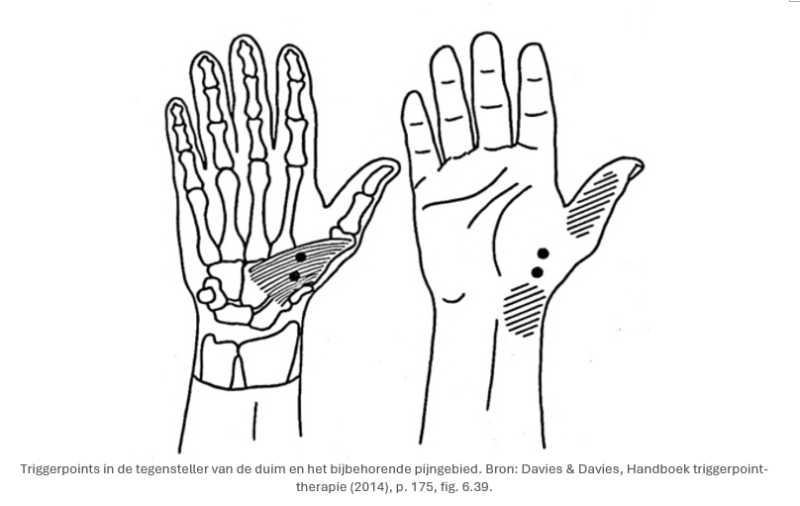 triggerpoints-in-de-tegensteller-van-de-duim-cts