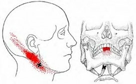 triggerpoints-in-de-tweebuikige-spier-digastricus-kaakpijn