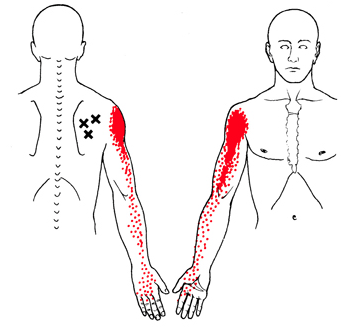 triggerpoints- onderdoorn spier infraspinatus pijn in de voorkant van de  schouder