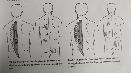 triggerpoints-rug-in-de-oppervlakkige-ruggengraatspieren-de-rugstrekker-erector-spinae-longissimus-iliocostalis-spinalis
