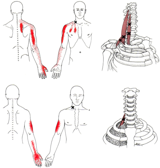 triggerpoints-schuine spieren scaleni nekpijn onderkant nek