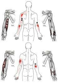 triggerpoints-triceps-pijn-bovenarm-elleboog-achterkant-schouder