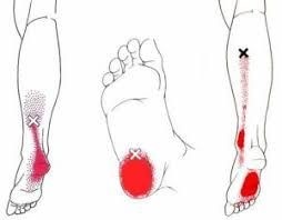 zenuwpijn benenTarsaal tunnel syndroom triggerpoints