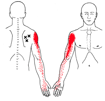 zenuwpijn-brachial-plexus-triggerpoints-infraspinatus