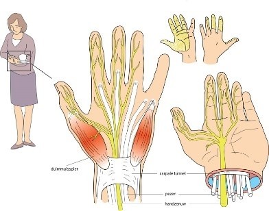 Zenuwpijn carpal tunnel syndroom.