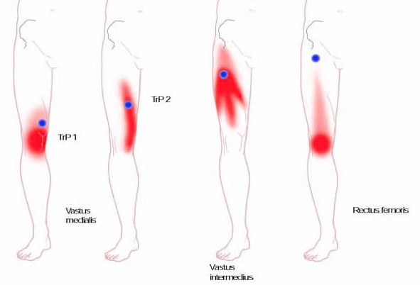 zenuwpijn-plexus-lumbaklis-triggerpoints-quadriceps