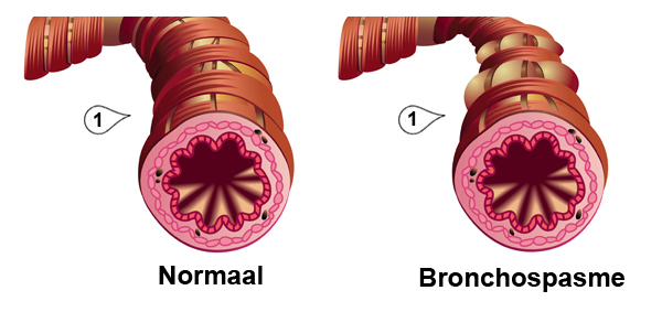 Bronchospasme