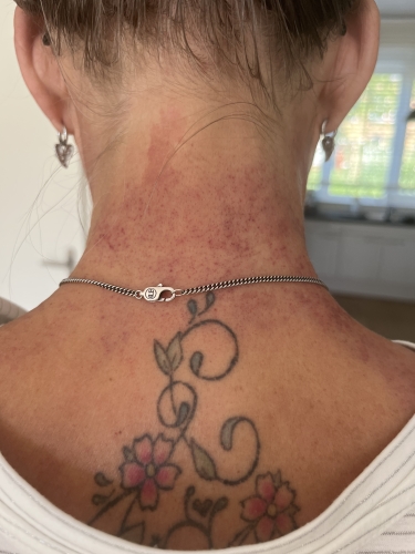 Transformational Cupping