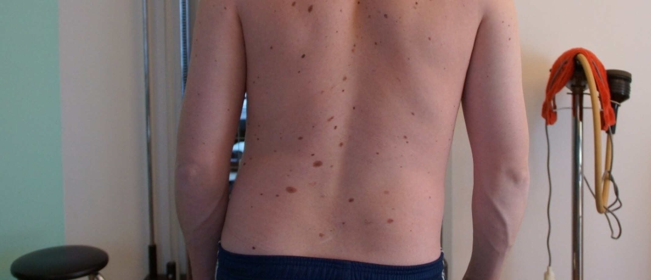 Scoliosis or a lateral shift, whats the difference