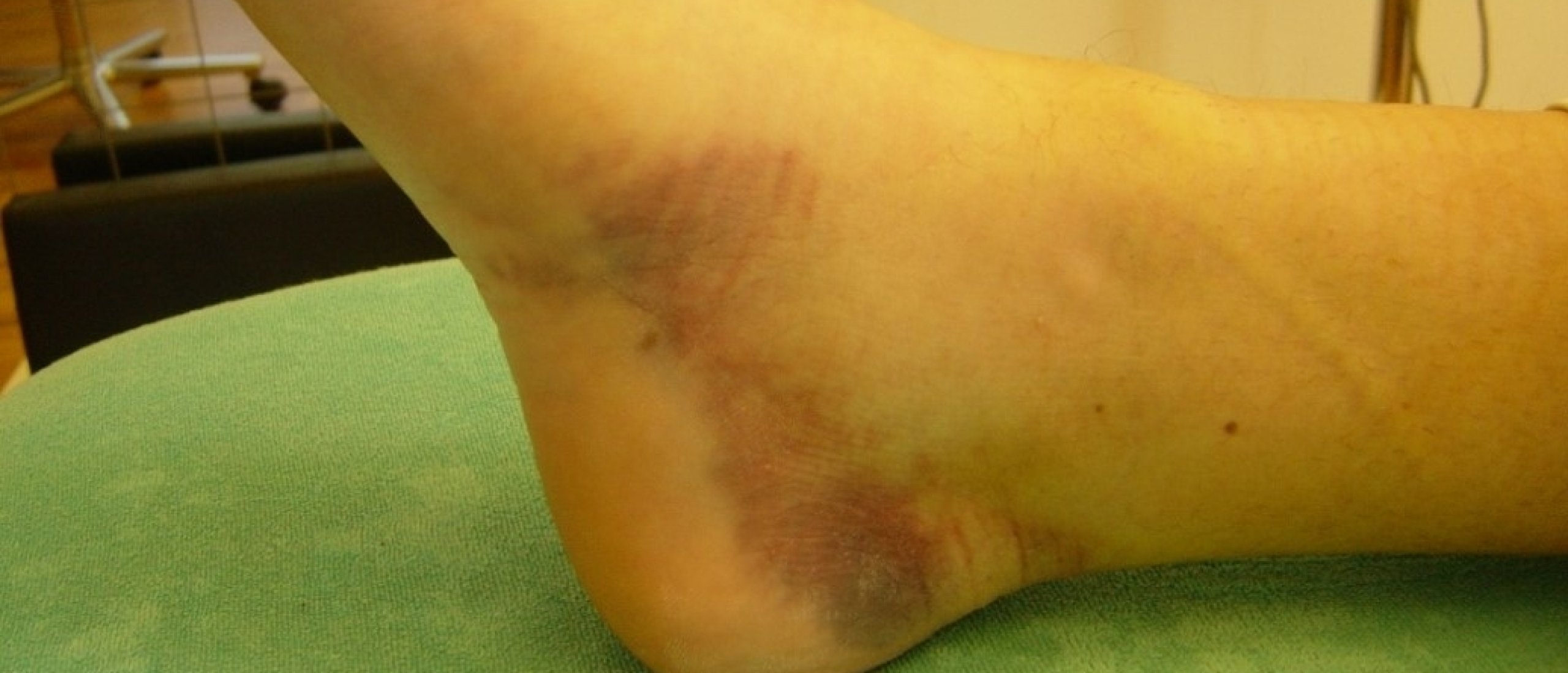 Ankle sprain differential diagnosis