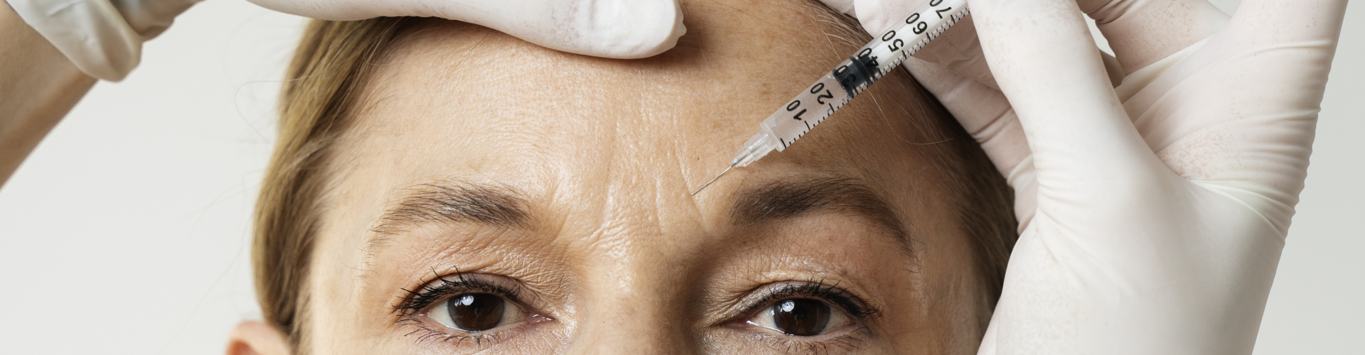 Cliënte ontvangt een Botox behandeling voor fronsrimpels bij De Botoxbar in Ottoland – veilige behandeling met Azzalure (Galderma) voor een ontspannen, natuurlijke uitstraling.