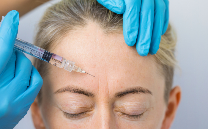 Cliënte krijgt een Botox behandeling voor fronsrimpels bij De Botoxbar in Ottoland. Na 3 tot 7 dagen ontspant de spier en wordt de fronslijn zichtbaar zachter, met een natuurlijk resultaat.