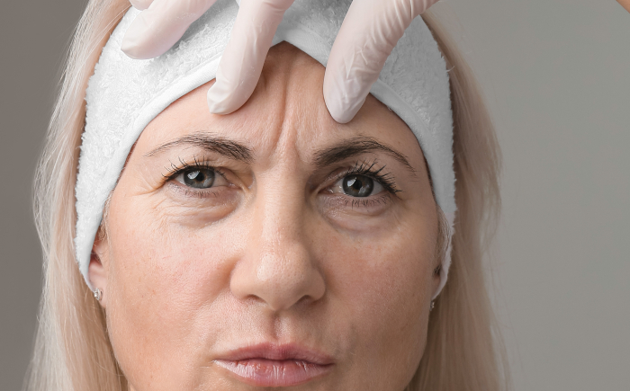 Vrouw met zichtbare fronsrimpel voor een Botox behandeling bij De Botoxbar in Ottoland. Botox ontspant de spieren tussen de wenkbrauwen, waardoor rimpels verminderen en de huid zich herstelt.