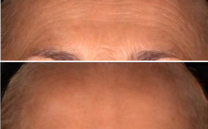Voor en na foto van een Botox behandeling van fronsrimpels bij De Botoxbar in Ottoland – zichtbaar zachtere en ontspannen uitstraling, met behoud van natuurlijke mimiek.