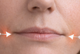 Botox hangende mondhoeken: waar wordt er geprikt? De Botoxbar legt uit