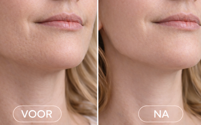 Botox voor en na - De botoxbar