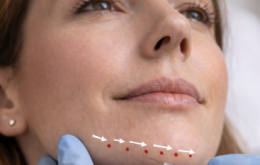 Botox kin: waar wordt er geprikt? De Botoxbar legt uit