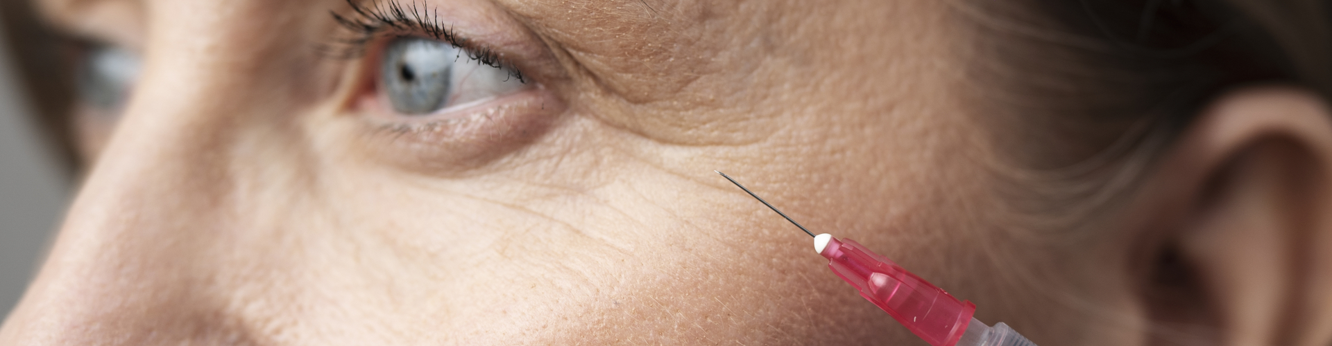 Botox kraaienpootjes – veilige en subtiele behandeling rond de ogen Botox kraaienpootjes behandeling bij de ooghoek uitgevoerd door specialist