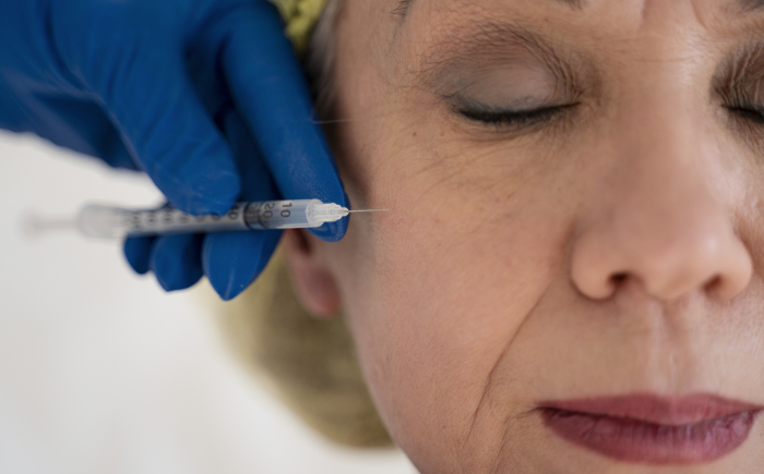 Botox kraaienpootjes €135 – veilig en professioneel behandeld Botox kraaienpootjes behandeling bij de ooghoek uitgevoerd door ervaren specialist