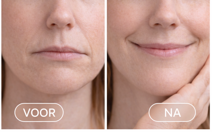 Botox mondhoeken voor en na door De Botoxbar