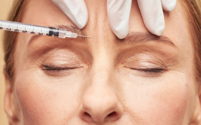 Injectiepunten bij botox tegen migraine: frons en voorhoofd Botox tegen migraine injecties in de frons en het voorhoofd