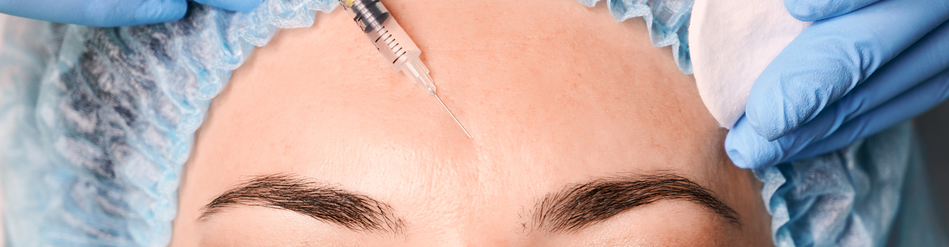 Botox voorhoofd – natuurlijk en veilig behandeld bij De Botoxbar Botox voorhoofd behandeling – injectie in voorhoofdsrimpels voor een natuurlijk resultaat