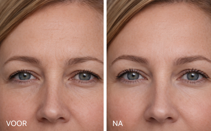 Botox wenkbrauwlift voor en na