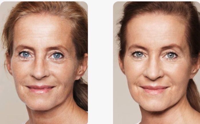 Skinbooster behandeling voor en na: Maar hoe verloopt een skinboosterbehandeling Skinbooster behandeling voor en na: Maar hoe verloopt een skinboosterbehandeling? De Botoxbar legt het uit