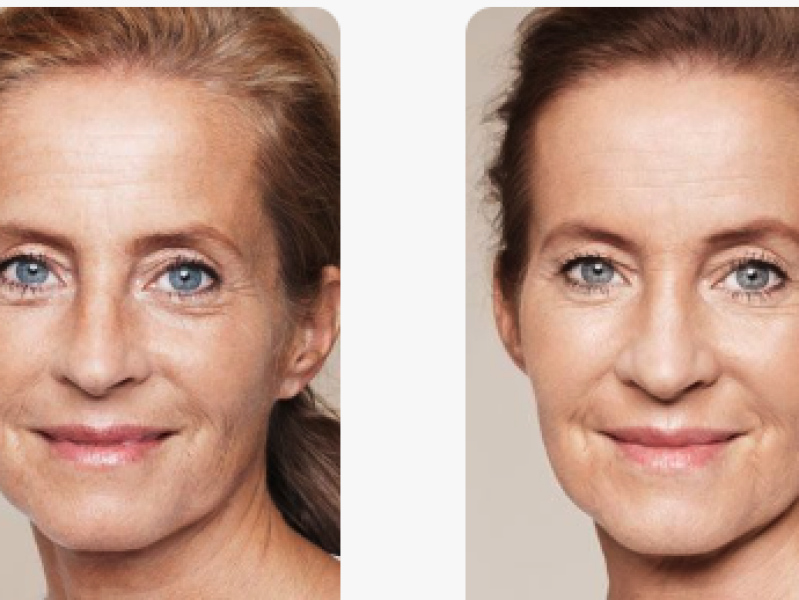 Skinbooster behandeling voor en na: Maar hoe verloopt een skinboosterbehandeling Skinbooster behandeling voor en na: Maar hoe verloopt een skinboosterbehandeling? De Botoxbar legt het uit