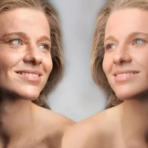 Hyaluronzuur filler behandeling nodig? De Botoxbar regelt het (voor en na foto's)