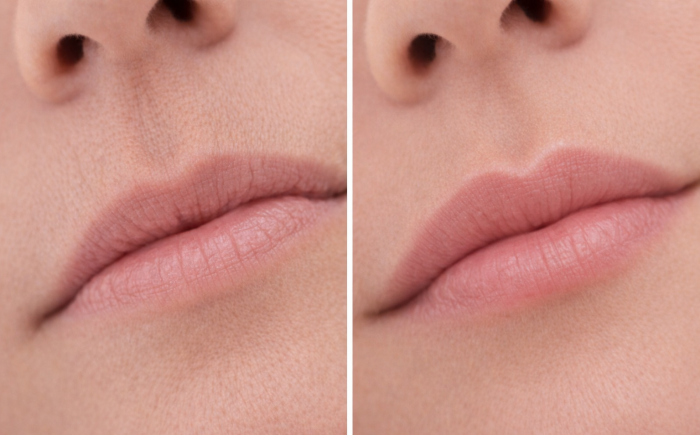 Voor en na resultaat van lipcontour behandeling met subtiele definitie van de liprand en cupidoboog
