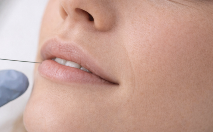 Close-up van lipflip behandeling met botox waarbij een dunne naald in de bovenlipspier wordt geplaatst