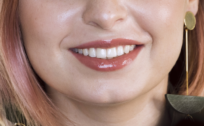 Close-up van een vrouw met een natuurlijke glimlach na een lipflip behandeling waarbij de bovenlip subtiel minder omhoog trekt