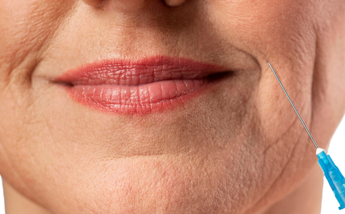 Nadelen van Botox bij mondhoeken? Die zijn er bijna niet. Lees meer
