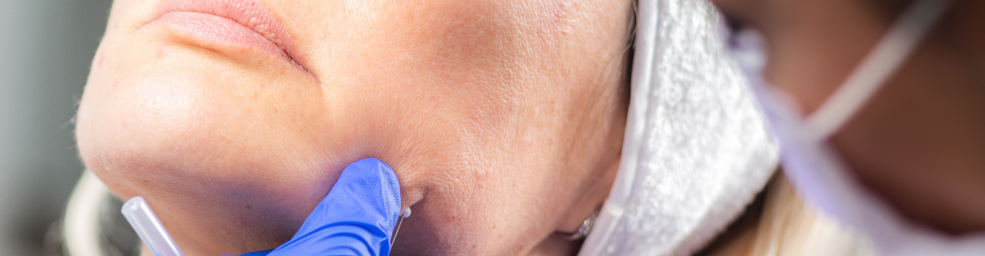 Profhilo Behandeling uitgevoerd door Monica van De Botoxbar