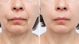 profhilo behandeling resultaat De Botoxbar door Monica uitgevoerd