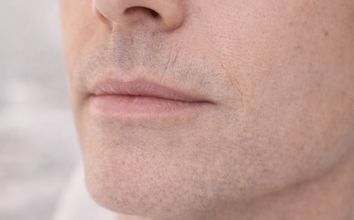 Close-up van rokerslijntjes boven de bovenlip bij man met subtiele verticale lijntjes