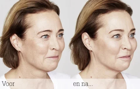 Voor en na Botoxbehandeling – natuurlijk resultaat bij De Botoxbar Ottoland (regio Gorinchem, Dordrecht, Utrecht) Voor en na Botoxbehandeling van kraaienpootjes bij De Botoxbar in Ottoland – natuurlijk en ontspannen resultaat voor cliënten uit Gorinchem, Dordrecht, Sliedrecht, Alblasserdam, Papendrecht en Utrecht.