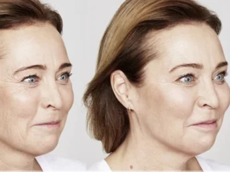 Voor en na Botoxbehandeling van kraaienpootjes bij De Botoxbar in Ottoland – natuurlijk en ontspannen resultaat voor cliënten uit Gorinchem, Dordrecht, Sliedrecht, Alblasserdam, Papendrecht en Utrecht.