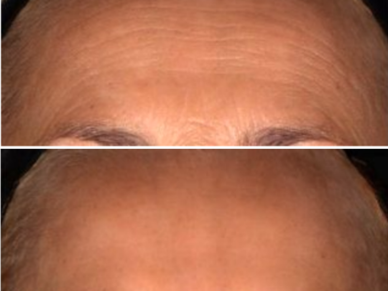 Voor en na een botoxbehandeling voorhoofd door De Botoxbar