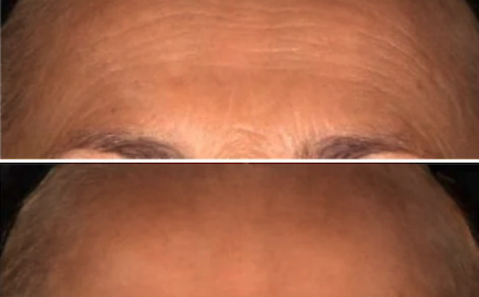 Botox voorhoofd – natuurlijk voor en na resultaat Voor en na resultaat van Botox voorhoofd behandeling met zichtbaar verzachte horizontale voorhoofdsrimpels