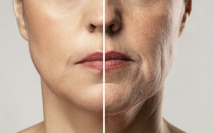 Voor en na Hyaluronzuur Filler Behandeling bij De Botoxbar