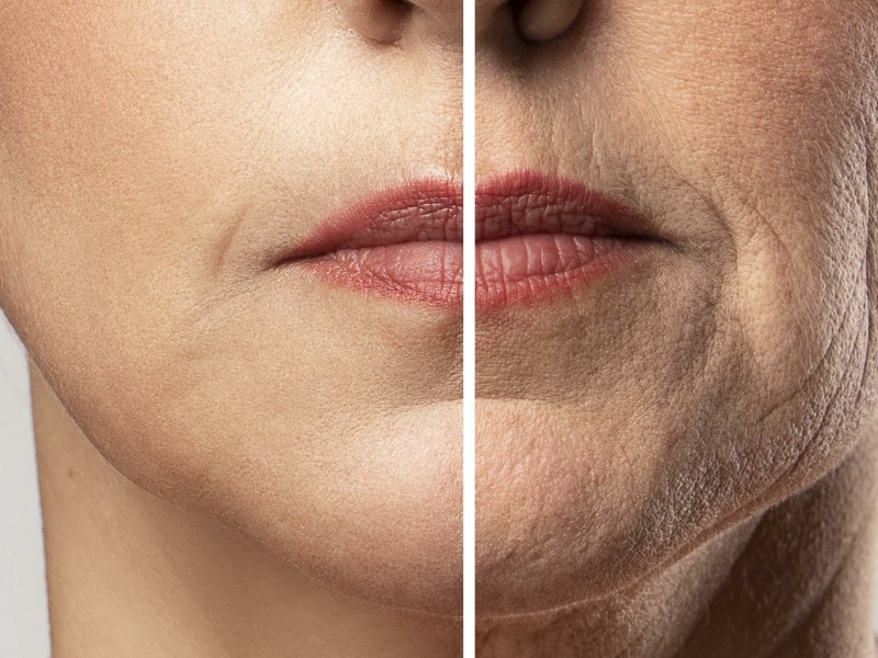 Voor en na Hyaluronzuur Filler Behandeling bij De Botoxbar