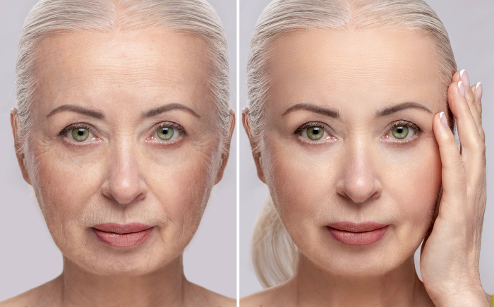 Profhilo behandeling een van de meest natuurlijke huidverjongende opties