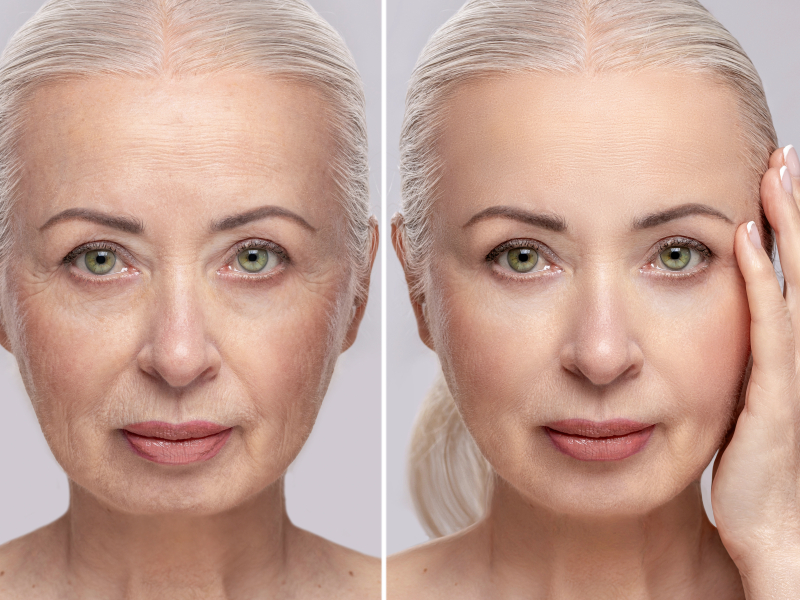 Profhilo behandeling een van de meest natuurlijke huidverjongende opties