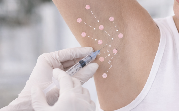 Injectiepunten van botox tegen overmatig zweten in de oksels